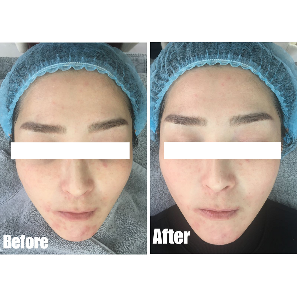 sMTS Crystal Mask Pack Kit - 5pcs/ box